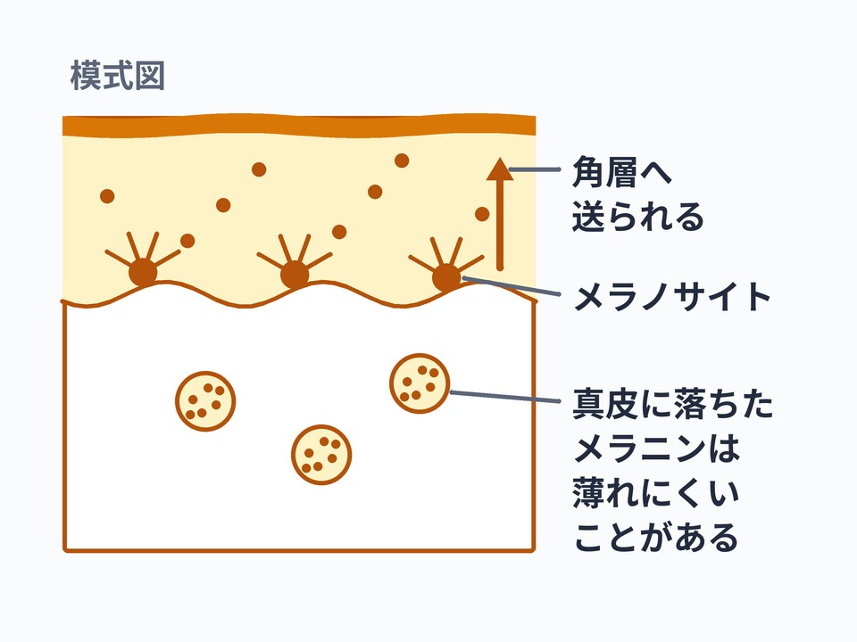 色素沈着